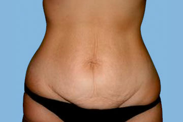 ¿Qué es BodyTite y por qué en el Instituto Pérez de la Romana recomendamos técnicas más avanzadas? Abdominoplastia-1-Antes-e1753182777952