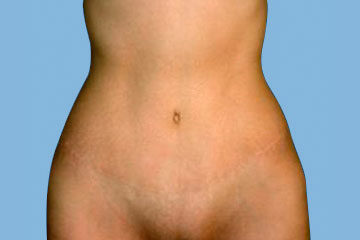¿Qué es BodyTite y por qué en el Instituto Pérez de la Romana recomendamos técnicas más avanzadas? Abdominoplastia-1-Despues-e1753182805597