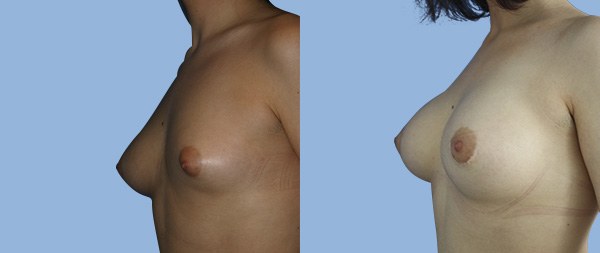 Breast asymmetry Asimetria-de-Mamas-02-Instituto-Perez-de-la-Romana