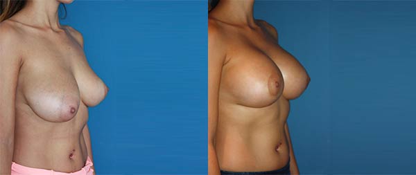 Breast asymmetry Asimetria-de-Mamas-04-Instituto-Perez-de-la-Romana