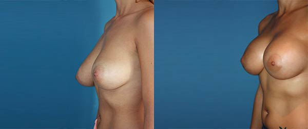 Breast asymmetry Asimetria-de-Mamas-05-Instituto-Perez-de-la-Romana