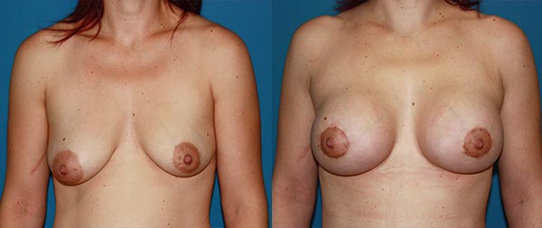 Breast asymmetry Asimetria-de-Mamas-06-Instituto-Perez-de-la-Romana