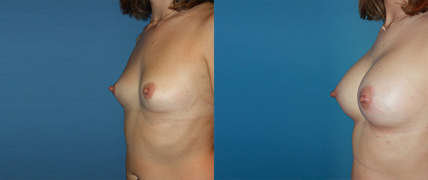 Увеличение груди Aumento-de-mamas-14-Instituto-Perez-de-la-Romana