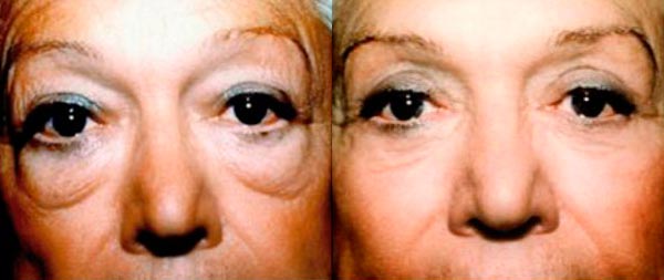 Blefaroplastia: operación de párpados caídos, bolsas en los ojos y ojeras Blefaroplastia-01-Instituto-Perez-de-la-Romana-1