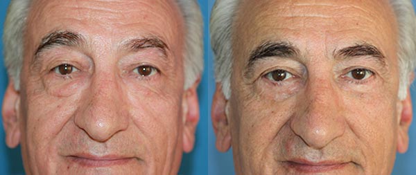 Blepharoplasty, male eyelid rejuvenation Blefaroplastia-03-Instituto-Perez-de-la-Romana-3