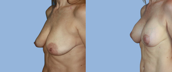 Breast elevation (mastopexy) Elevacion-de-Mamas-09-Instituto-Perez-de-la-Romana