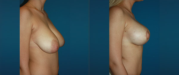 Breast elevation (mastopexy) Elevacion-de-Mamas-15-Instituto-Perez-de-la-Romana