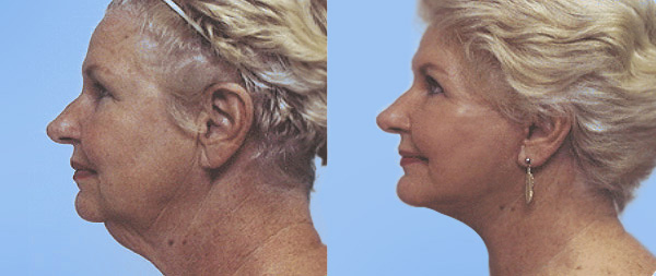 Cómo lograr una apariencia más joven y natural con el lifting de cuello Lifting-Facial-03-instituto-Perez-de-la-Romana