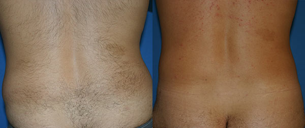 Male liposuction Liposuccion-12-Instituto-Perez-de-la-Romana-3
