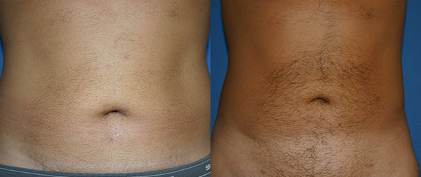 Male liposuction Liposuccion-13-Instituto-Perez-de-la-Romana-3