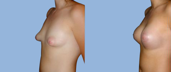 Коррекция тубулярной груди Mamas-Tubulares-02-Instituto-Perez-de-la-Romana-2