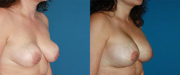 Recambio o retirada definitiva de prótesis mamarias Recambio-Protesis-02-Instituto-Perez-de-la-Romana-1