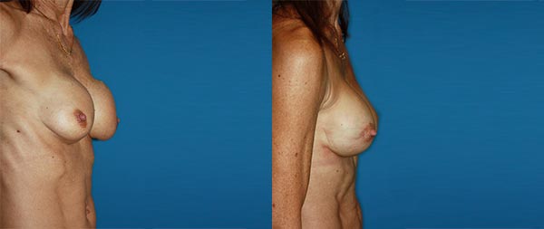 Recambio o retirada definitiva de prótesis mamarias Recambio-Protesis-05-Instituto-Perez-de-la-Romana-1