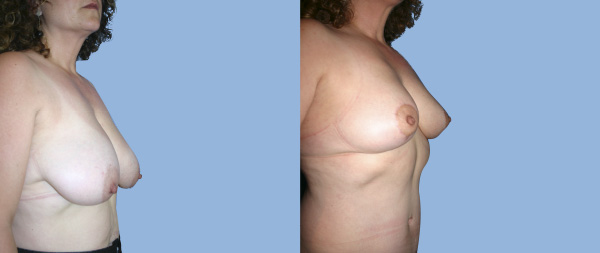 Breast reduction Reduccion-de-mamas-05-Instituto-Perez-de-la-Romana