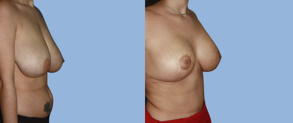 Breast reduction Reduccion-de-mamas-06-Instituto-Perez-de-la-Romana