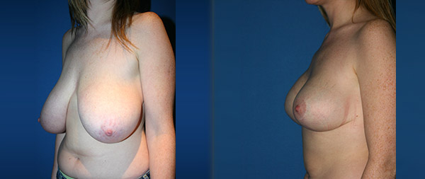 Уменьшение груди Reduccion-de-mamas-09-Instituto-Perez-de-la-Romana