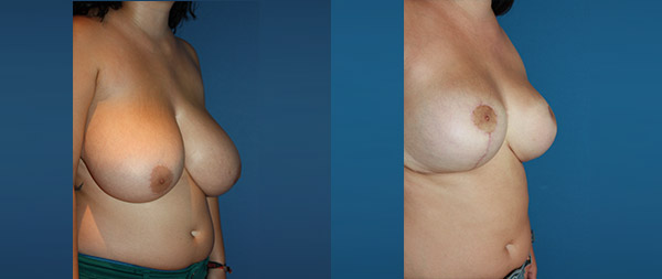 Уменьшение груди Reduccion-de-mamas-14-Instituto-Perez-de-la-Romana