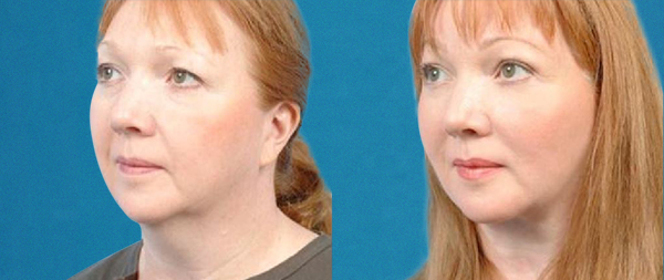 Lifting facial sin cirugía: FaceTite, NeckTite y AccuTite caso-1-1