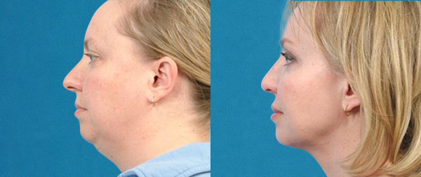 Lifting facial sin cirugía: FaceTite, NeckTite y AccuTite caso-2-1