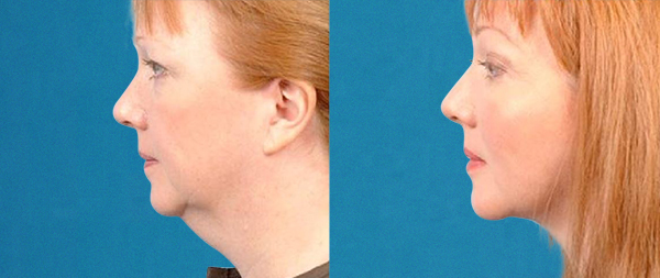 Lifting facial sin cirugía: FaceTite, NeckTite y AccuTite caso-3