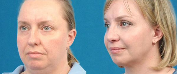 Lifting facial sin cirugía: FaceTite, NeckTite y AccuTite caso-4