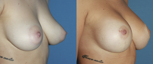 Breast elevation (mastopexy) Elevacion-de-Mamas-octubre-2-2020-Instituto-Perez-de-la-Romana
