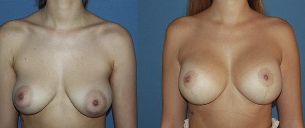 Breast elevation (mastopexy) Elevacion-de-Mamas-octubre-2020-Instituto-Perez-de-la-Romana