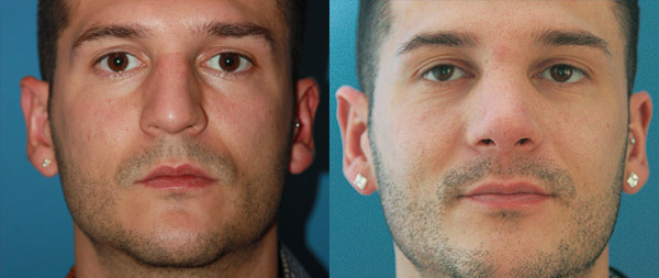 Male rhinoplasty caso-rinoplastia-n2b