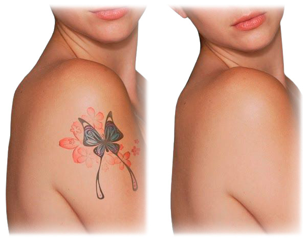 Eliminación de Tatuajes en Alicante con Remoción Química tatuaje-borrado
