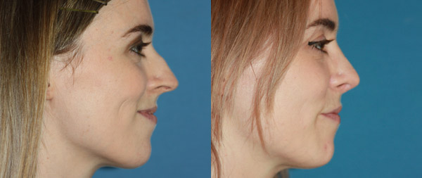 Operación de nariz: Rinoplastia ultrasónica caso-rinoplastia-27-8-21-perfil