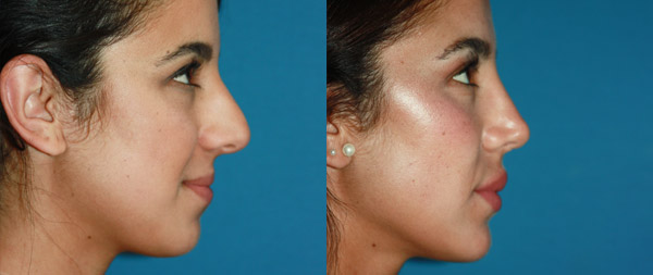 Operación de nariz: Rinoplastia ultrasónica caso-rinoplastia-n-zai-dcho
