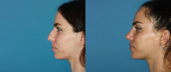 Operación de nariz: Rinoplastia ultrasónica rinoplastia_2022-08-25_1005-2