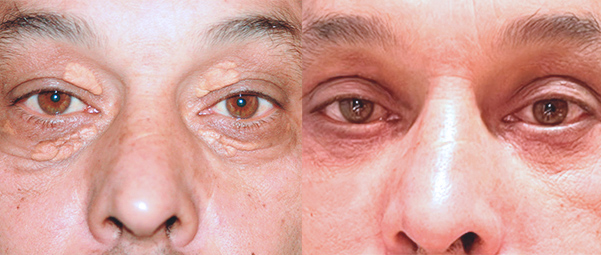 Blefaroplastia: operación de párpados caídos, bolsas en los ojos y ojeras blefaroplastia-tratamiento-abril-2023