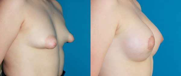Todo sobre la corrección de mamas tubulares prepost-pecho-tuberoso12-23-1-2