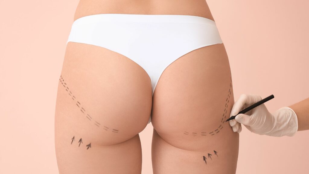 lipofilling