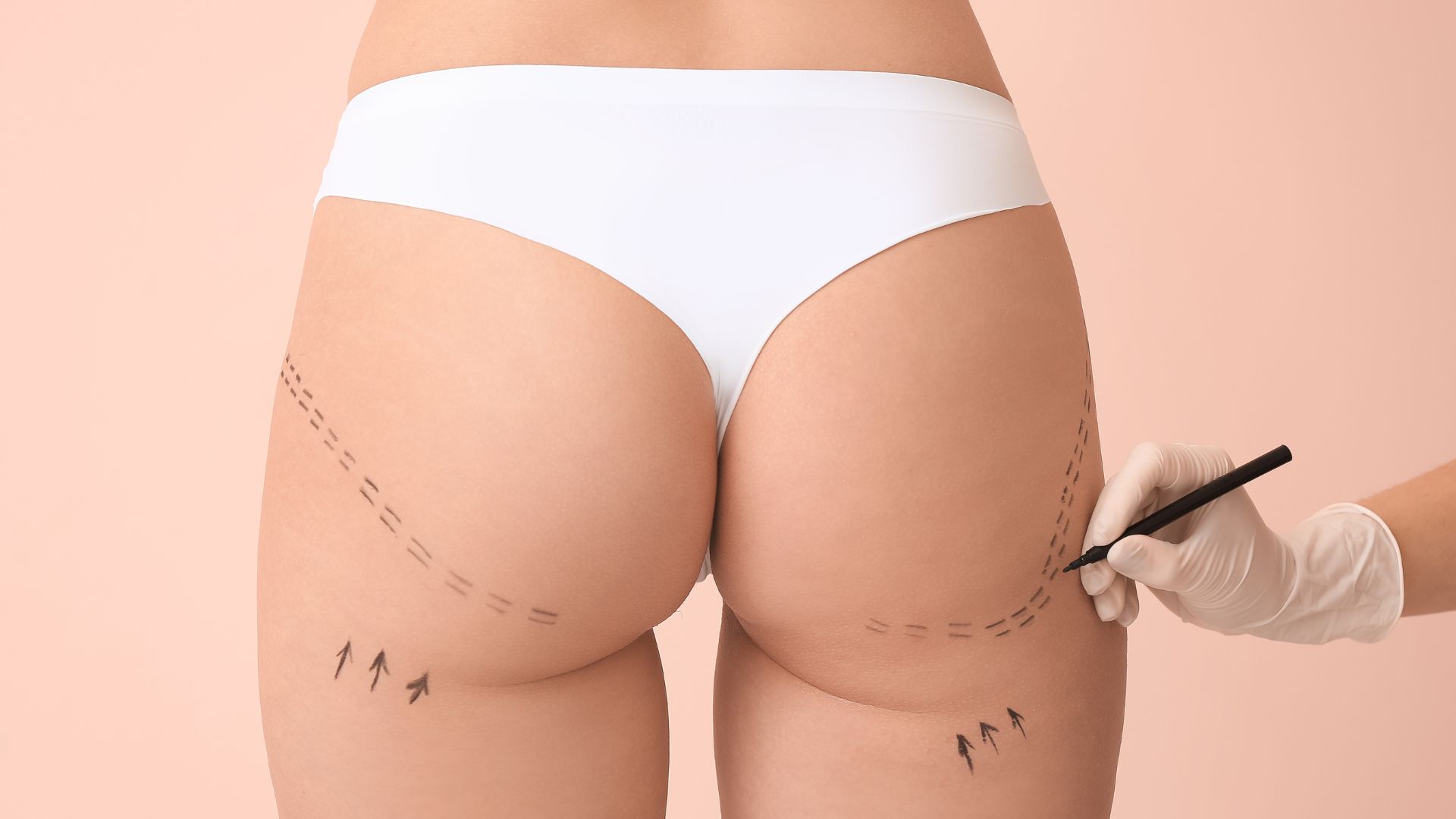 lipofilling