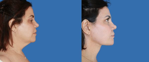 Lifting Facial Lifting Facial necklift-renuvion-lipovaser-dr.-perez-de-la-romana-600x253-1