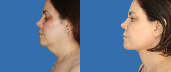 Lifting Facial Lifting Facial necklift-renuvion-lipovaser-dr.-perez-de-la-romana-600x253-2