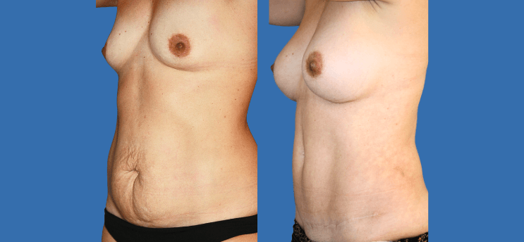 Mommy Makeover en Alicante | Recupera tu figura tras el embarazo Mommy Makeover en Alicante | Recupera tu figura tras el embarazo mommy-makeover-case-1-2