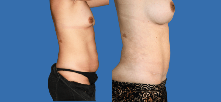 Mommy Makeover en Alicante | Recupera tu figura tras el embarazo Mommy Makeover en Alicante | Recupera tu figura tras el embarazo mommy-makeover-case-1-3