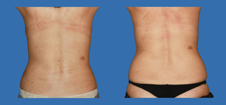 Mommy Makeover en Alicante | Recupera tu figura tras el embarazo Mommy Makeover en Alicante | Recupera tu figura tras el embarazo mommy-makeover-case-1-4