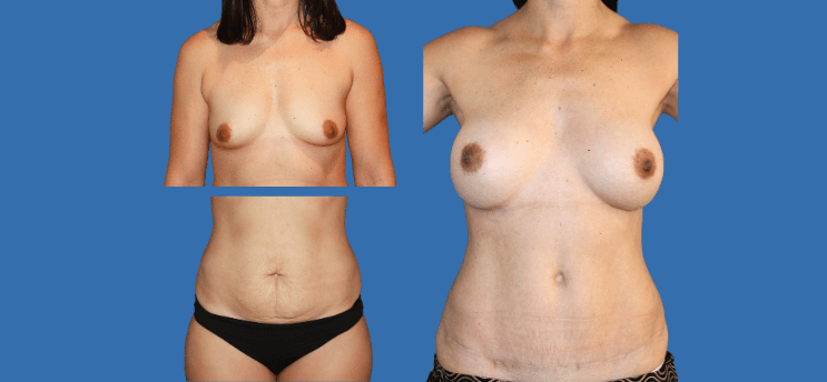 Mommy Makeover en Alicante | Recupera tu figura tras el embarazo Mommy Makeover en Alicante | Recupera tu figura tras el embarazo mommy-makeover-case-1