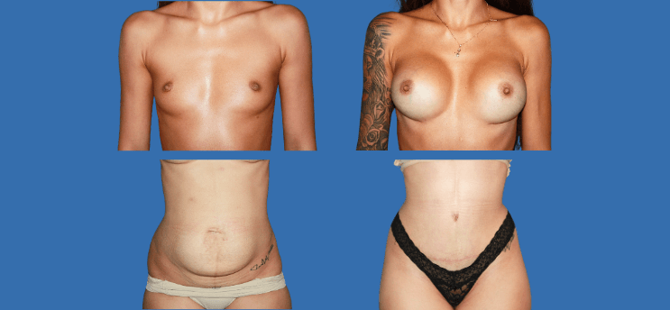 Mommy Makeover en Alicante | Recupera tu figura tras el embarazo Mommy Makeover en Alicante | Recupera tu figura tras el embarazo mommy-makeover-case-2-2