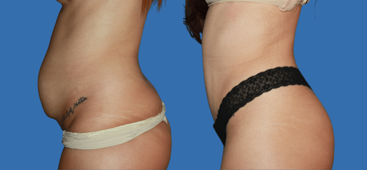 Mommy Makeover en Alicante | Recupera tu figura tras el embarazo Mommy Makeover en Alicante | Recupera tu figura tras el embarazo mommy-makeover-case-2-3