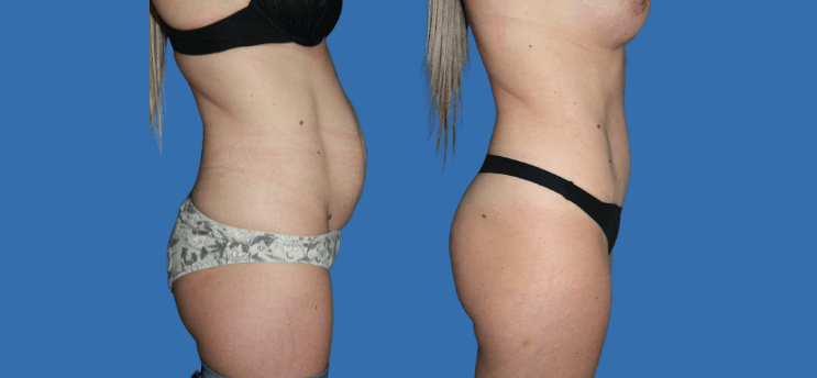 Mommy Makeover en Alicante | Recupera tu figura tras el embarazo Mommy Makeover en Alicante | Recupera tu figura tras el embarazo mommy-makeover-case-4-4