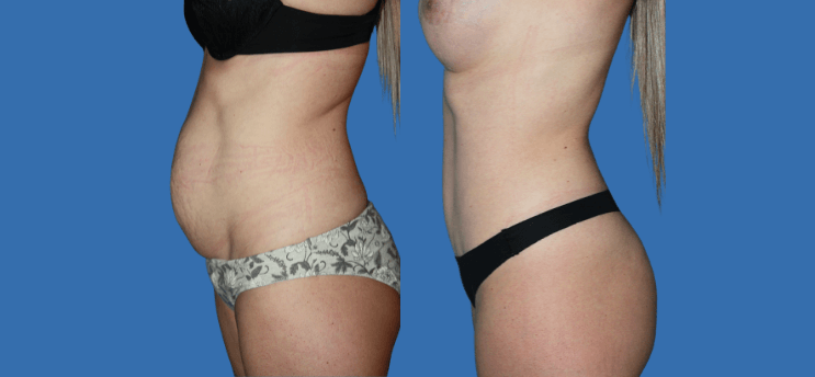 Mommy Makeover en Alicante | Recupera tu figura tras el embarazo Mommy Makeover en Alicante | Recupera tu figura tras el embarazo mommy-makeover-case-4-5