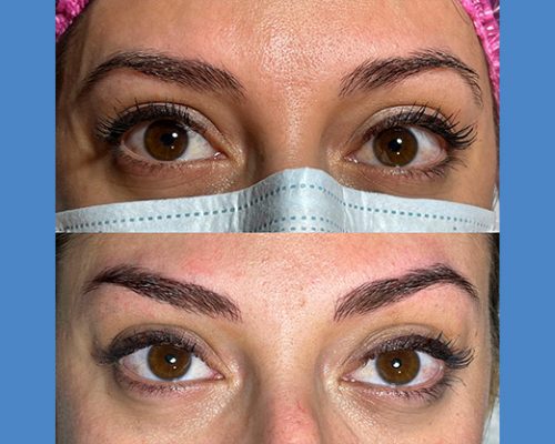 Brows Microblading and Eyelashes Extension in Alicante antes-despues-microblanding-4-1-pa764x5yt2quc68olixdoos81z1fszvu2a6y9dchi8