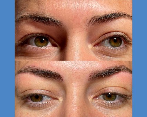 Brows Microblading and Eyelashes Extension in Alicante antes-despues-microblanding-6-1-pa765llrqroaq196mthohim7hzozd4kutn5kqkc90g