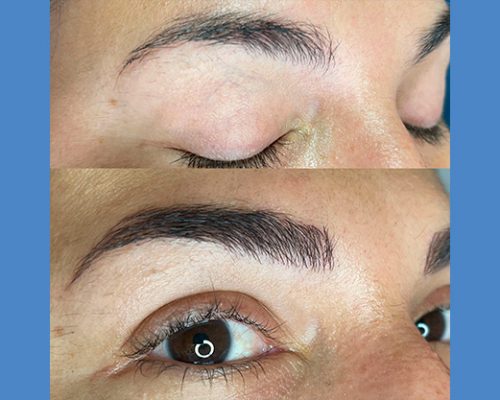 Brows Microblading and Eyelashes Extension in Alicante antes-despues-microblanding-9-1-pa766cv38ypm2q5l7n9uztqkq5ymkcl2le2nnl7u00